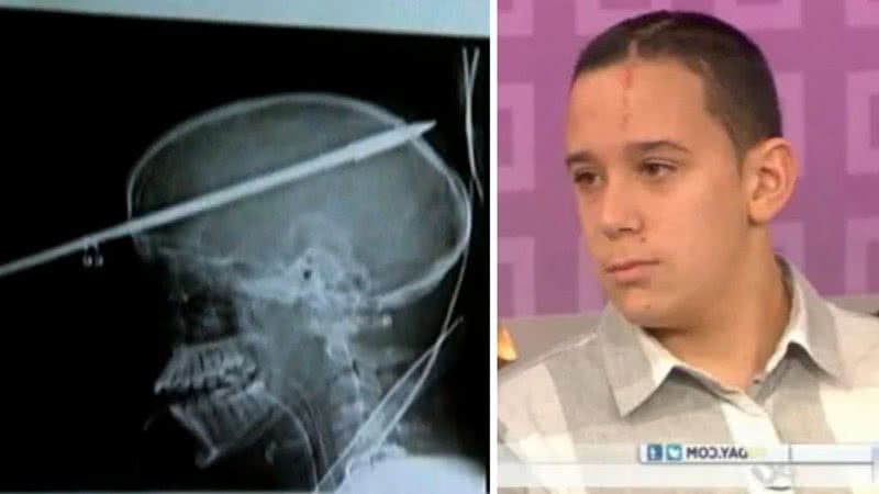 O garoto Yasser teve o crânio atravessado por um arpão - Divulgação/vídeoYoutube/On Demand News