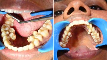 Kalpana Balan possui seis dentes a mais do que a maioria das pessoas - Divulgação/Guinness World Records