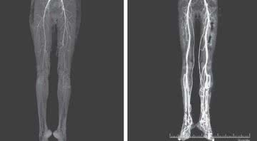 Raio-x da paciente antes e depois do tratamento - Divulgação/The New England Journal of Medicine