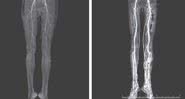 Raio-x da paciente antes e depois do tratamento - Divulgação/The New England Journal of Medicine