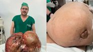Á esquerda imagem de médico com o tumor e à direita tumor no momento da cirurgia - Reprodução/Arquivo pessoal e Reprodução/Vídeo/UOL