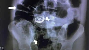 Fotografia de raio-X do abdômen do homem - Divulgação/ Clinics in Colon and Rectal Surgery
