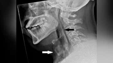 Radiografia do pescoço de homem que rompeu traqueia ao segurar espirro no Reino Unido - Divulgação/BMJ Case Reports 2023