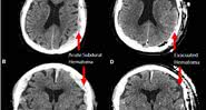 Tomografia computadorizada realizada para o estudo - Divulgação/Frontiers in Aging Neuroscience