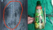 Montagem mostrando raio-X que identificou presença do objeto, e a embalagem após sua retirada via cirurgia - Divulgação/ Manoj Chowdhary