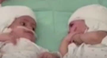 Gêmeas se vendo pela primeira vez, após cirurgia de separação - Divulgação/Youtube/RTÉ News
