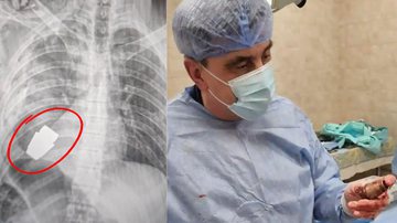 Montagem mostrando raio-X do paciente, e médico segurando a granada após a operação - Divulgação/ Governo da Ucrânia