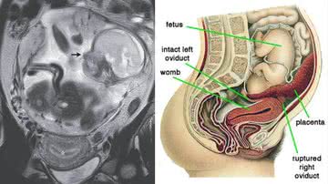 Montagem mostrando imagem de ultrassom da mulher e ilustração mostrando qual foi o seu caso - Divulgação/ New England Journal of Medicine e Divulgação/ Wikimedia Commons
