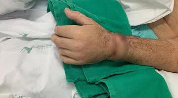O homem teve a mão reimplantada - Divulgação/Hospital Santo Antônio