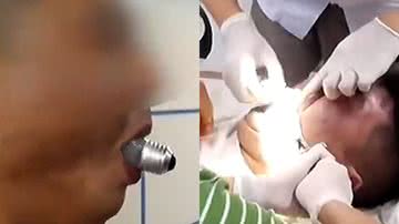Imagens de vídeo de socorro a homem com lâmpada presa na boca - Reprodução/Vídeo/YouTube/cgtnamerica