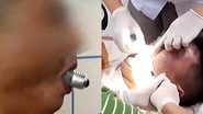 Imagens de vídeo de socorro a homem com lâmpada presa na boca - Reprodução/Vídeo/YouTube/cgtnamerica