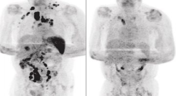 Exame de tomografia do paciente que mostra a remissão da doença - Divulgação/ British Journal of Haematology