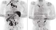 Exame de tomografia do paciente que mostra a remissão da doença - Divulgação/ British Journal of Haematology