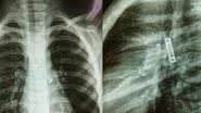 Raios X do garoto que teve a mola de metal presa em seu pulmão durante três meses - Reprodução/Instagram