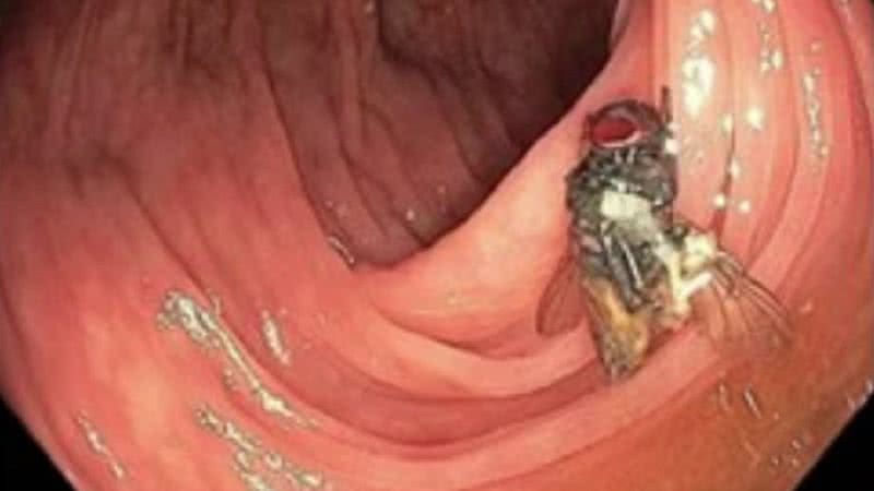 A mosca no intestino do paciente - The American Journal of Gastroenterology