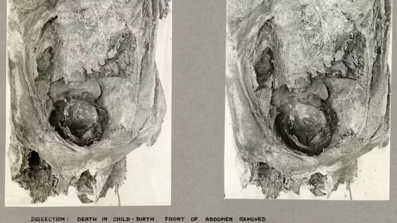 Imagem da cabeça de bebê presa na pélvis de múmia - Reprodução/International Journal of Osteoarchaeology