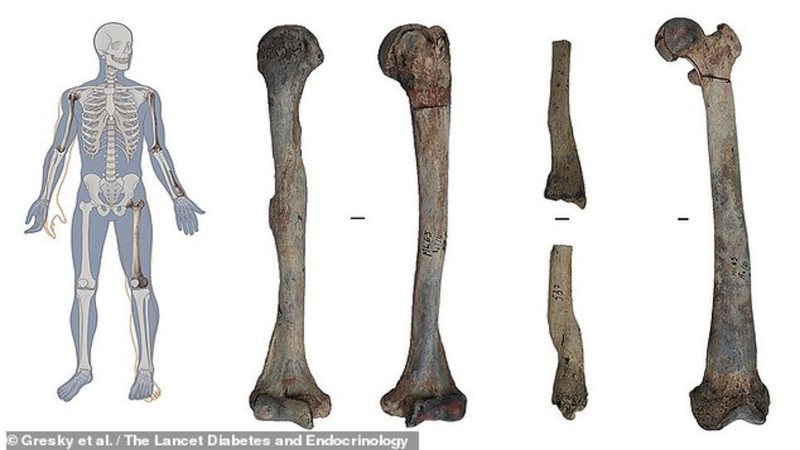 À direita, os restos mortais do homem e, à esquerda, os ossos danificados pela doença - Gresky et al. / The Lancet Diabetes and Endocrinology