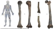 À direita, os restos mortais do homem e, à esquerda, os ossos danificados pela doença - Gresky et al. / The Lancet Diabetes and Endocrinology