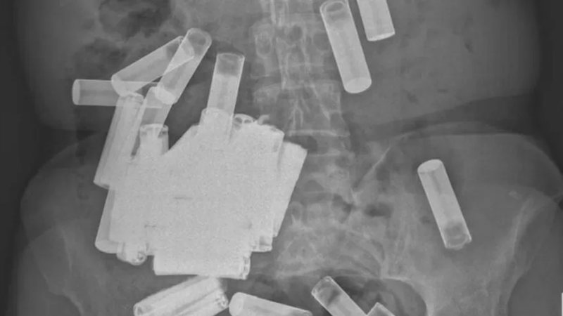 Pilhas encontradas dentro da mulher após radiografia - Divulgação/Irish Medical Journal