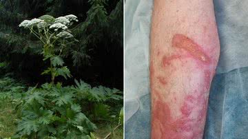 A planta gigante hogweed e os ferimentos causados em Jayden - Fritz Geller-Grimm via Wikimidia Commons e Annemarie Channon