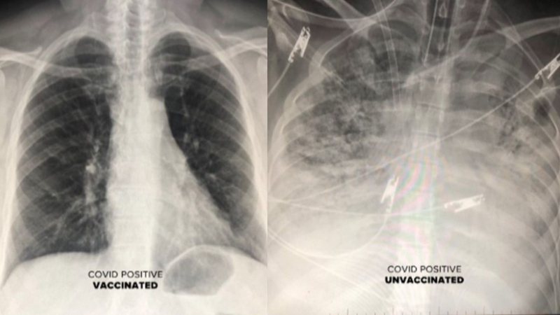 Fotografia mostrando dois exames, à esquerda um paciente com covid-19 que foi imunizado, e à direita um que não recebeu a vacina - Divulgação/ Sam Durani