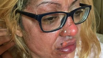 Mulher que queimou o rosto ao tentar cozinha ovo no micro-ondas - Reprodução / Redes Sociais