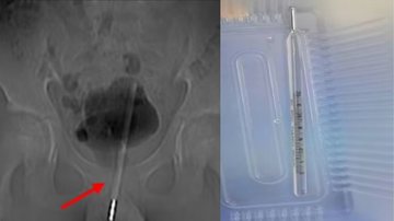 Montagem mostrando imagem de raio-x do termômetro, e fotografia após a remoção dele - Divulgação/ Asian Journal of Surgery
