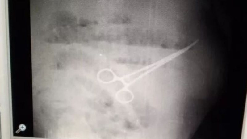 Radiografia mostra tesoura dentro do estômago do homem - Divulgação/Twitter/@EjeNoticias1