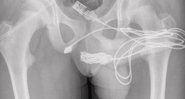 O raio x do caso - Divulgação/Urulogy Case Reports