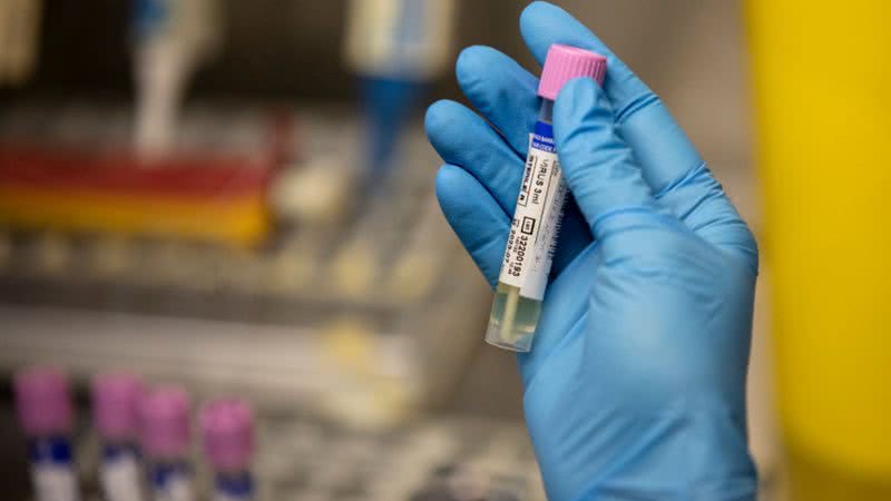 Técnico de laboratório mostra uma amostra suspeita de varíola dos macacos no laboratório - Getty Images