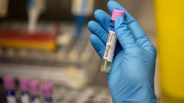 Técnico de laboratório mostra uma amostra suspeita de varíola dos macacos no laboratório - Getty Images