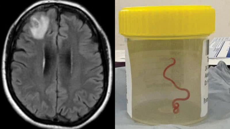 Imagem da ressonânica feita no cérebro da paciente e do o verme retirado do cérebro - Divulgação/Emerging Infectious Diseases