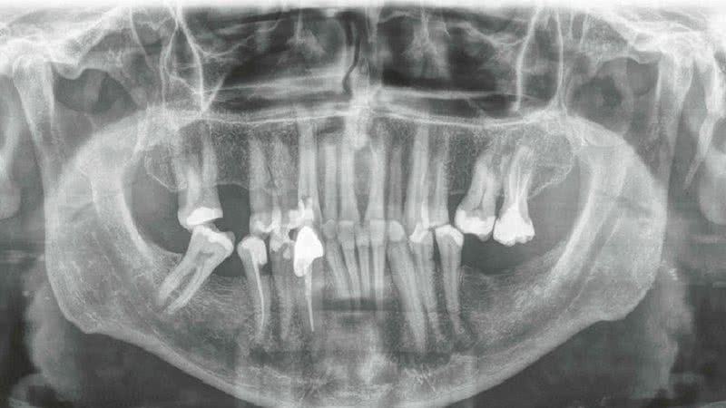 Raio-X do maior dente do mundo - Divulgação Dr. Max Lukas