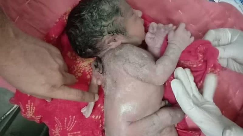 Bebê que nasceu com polimelia, condição que pode gerar coisas como a terceira mão nas costas do bebê - Reprodução/Vídeo/Daily Mail