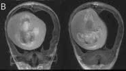Tomografia de menina chinesa que tinha feto gêmeo parasita no cérebro - Reprodução/Zongze Li et.al