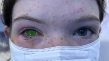 Fotografia que é possível observar olho esverdeado de pessoa atingida com doença na Austrália - Reprodução/Vídeo/Instagram