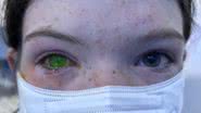 Fotografia que é possível observar olho esverdeado de pessoa atingida com doença na Austrália - Reprodução/Vídeo/Instagram