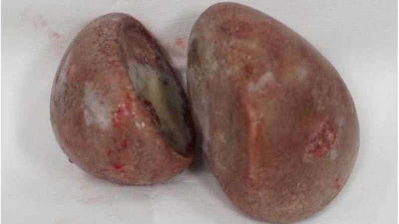 'Pedras' encontradas na vagina de uma paciente - Divulgação / Urology Case Reports