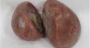 'Pedras' encontradas na vagina de uma paciente - Divulgação / Urology Case Reports
