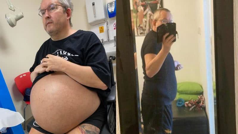 Fotografias do homem antes e depois da operação que salvou sua vida - Divulgação/ Warren Higgs/ Arquivo Pessoal