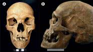 Crânio de homem do século 11 que apresentava síndrome rara enquanto vivo - Divulgação/The Lancet/Xavier Roca-Rada, MSc et.al