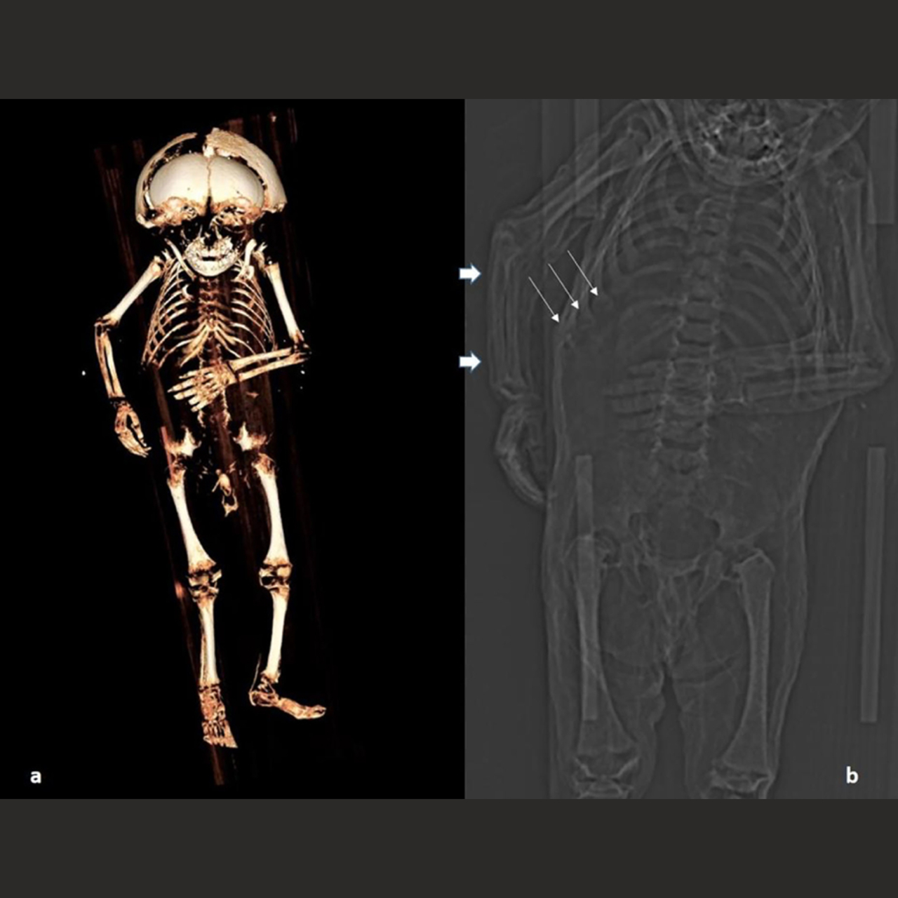 Reconstrução digital do esqueleto do menino