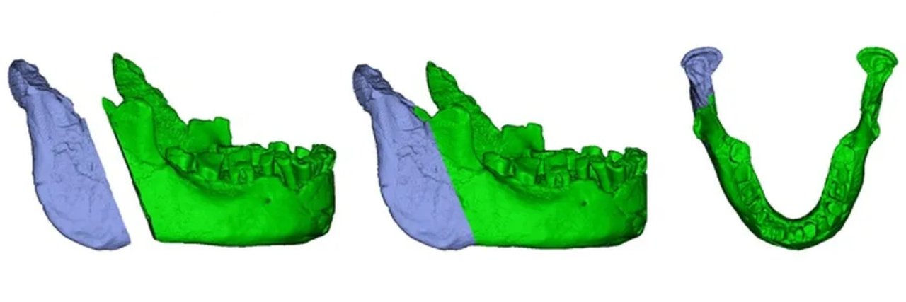 Reconstrução em 3D da mandíbula