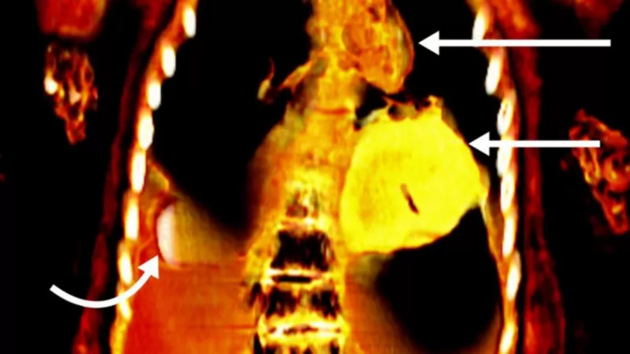 Tomografia em que é possível identificar coração de ouro em múmia de menino de 14 a 15 anos