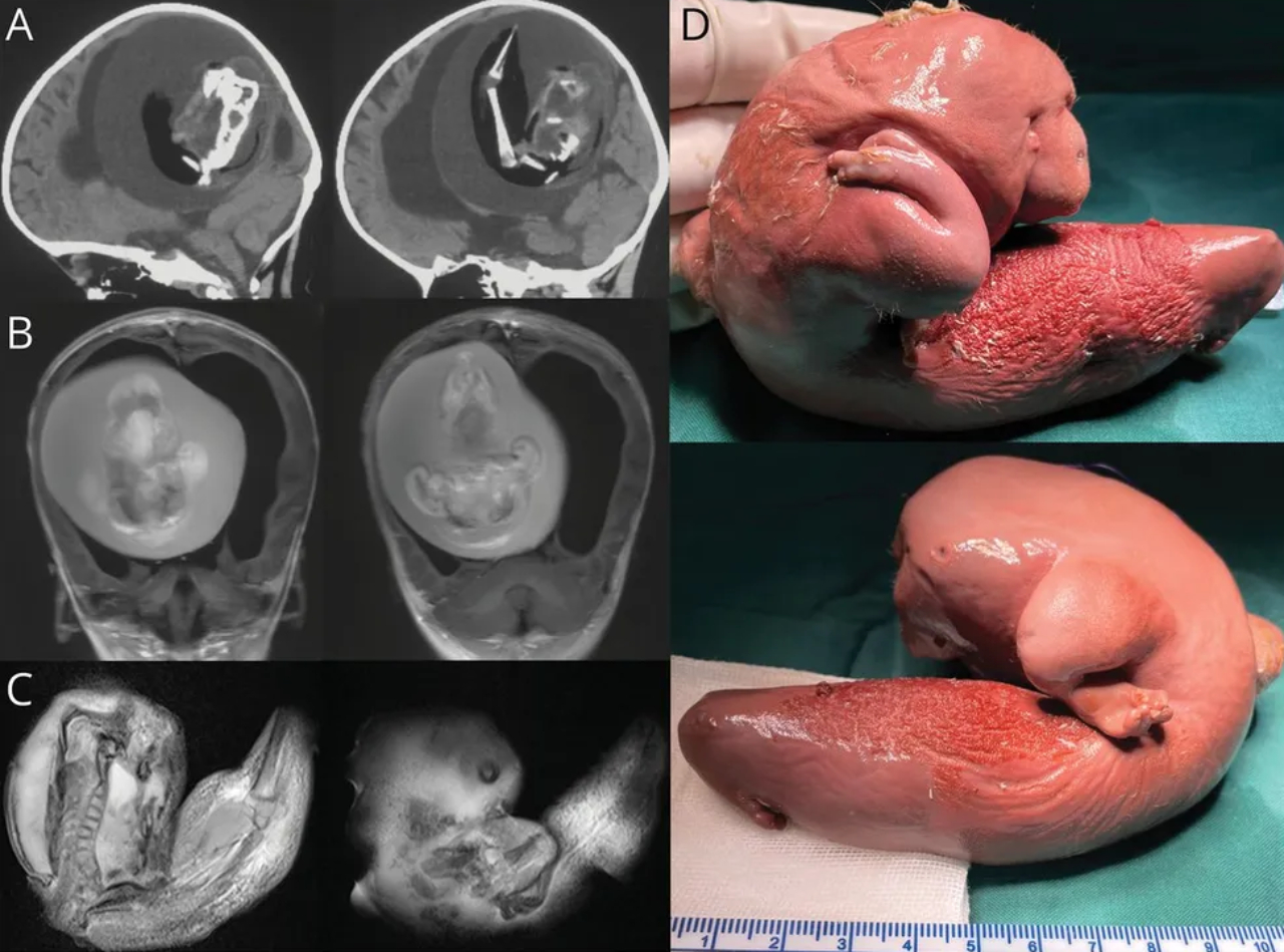 Imagens de tomografia da menina chinesa e do feto parasita removido