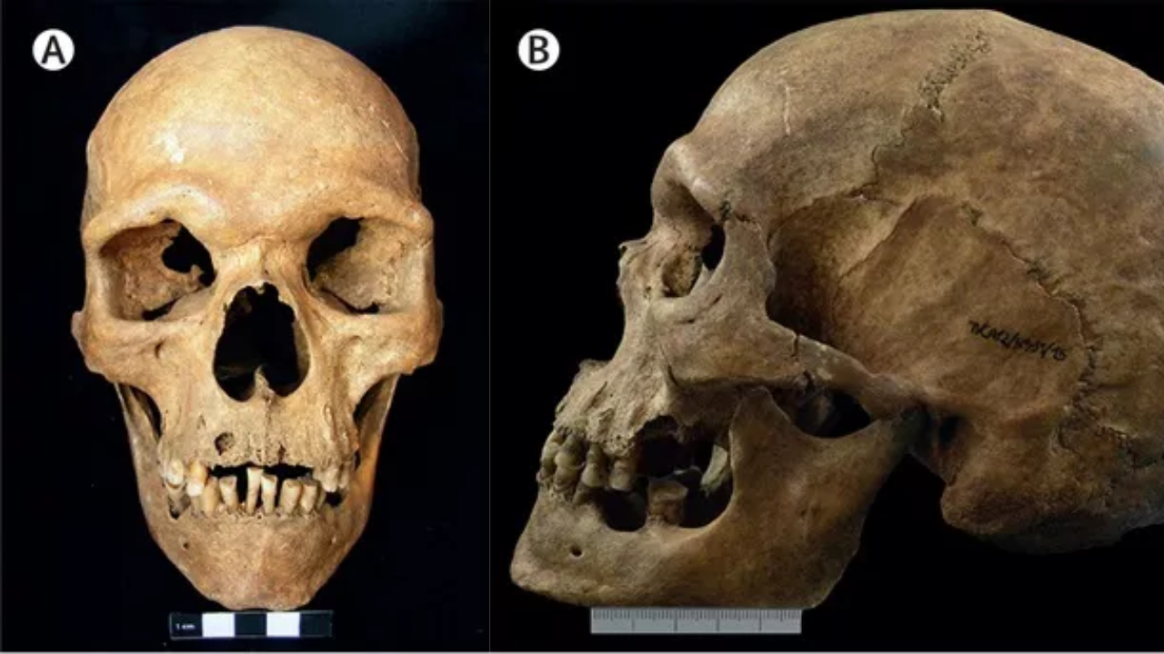 Fotografias de crânio de homem do século 11 com a Síndrome de Klinefelter